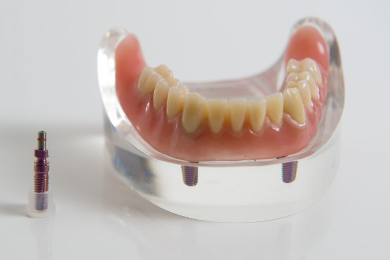 implantologie Winterswijk - Denarius Dental